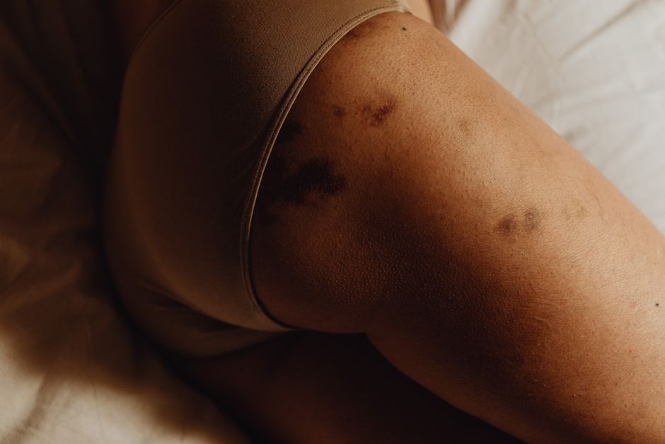 Intimate close-up of a woman's bruised skin, showing body positivity and natural beauty.