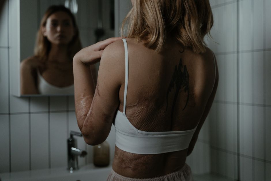 Portrait of a woman viewing her scarred back in a mirror, conveying a powerful message of resilience and self-acceptance.